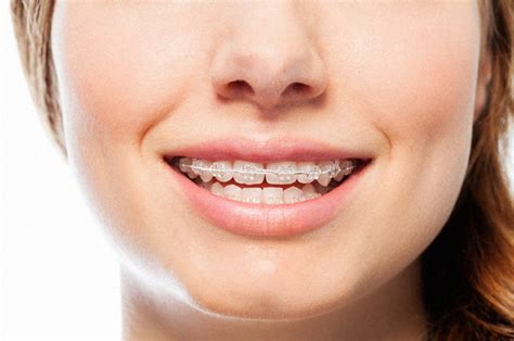 clear braces leatherhead|Invisible Braces: Pros, Cons, & Costs .